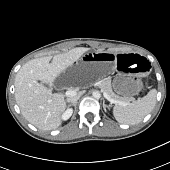 File:Adhesional small bowel obstruction (Radiopaedia 52107-57980 Axial C+ portal venous phase 26).jpg
