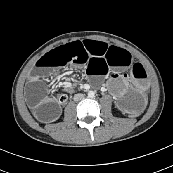 Adhesional small bowel obstruction (Radiopaedia 52107-57980 Axial C+ portal venous phase 63).jpg