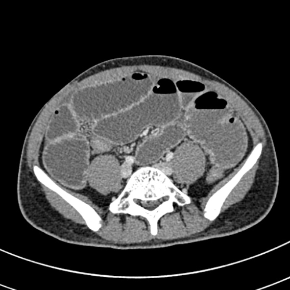 Adhesional small bowel obstruction (Radiopaedia 52107-57980 Axial C+ portal venous phase 85).jpg