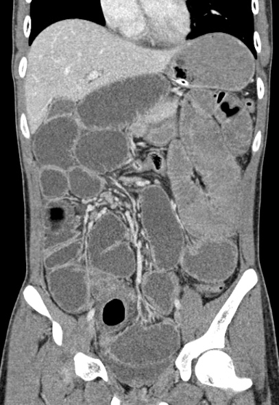 Adhesional small bowel obstruction (Radiopaedia 52107-57980 Coronal C+ portal venous phase 32).jpg