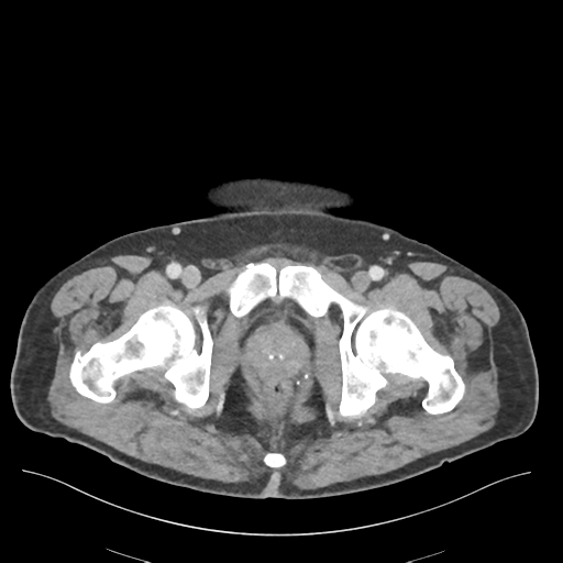 Adhesions within abdominal wall hernia (Radiopaedia 58283-65394 Axial C+ portal venous phase 83).png