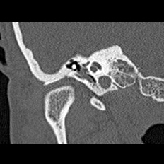 File:Adhesive chronic otitis media (Radiopaedia 14270-14148 Coronal bone window - right 6).jpg