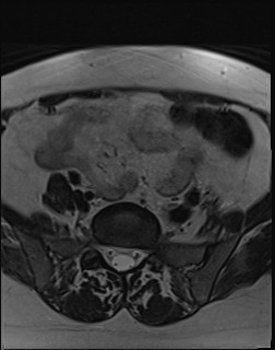 File:Adnexal multilocular cyst (O-RADS US 3- O-RADS MRI 3) (Radiopaedia 87426-103754 Axial T2 2).jpg