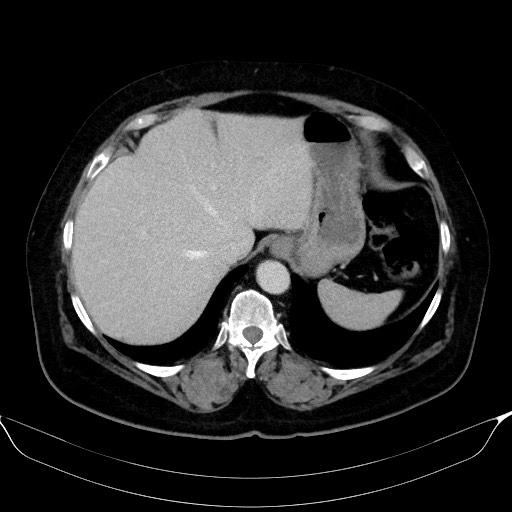 File:Adrenal cortical carcinoma (Radiopaedia 64017-72769 Axial C+ portal venous phase 11).jpg