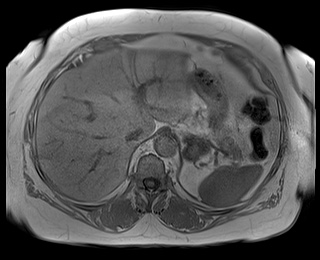 File:Adrenal cortical carcinoma (Radiopaedia 64017-72770 Axial T1 in-phase 14).jpg