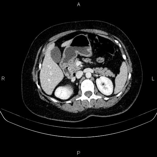Adrenal cortical carcinoma (Radiopaedia 84882-100379 Axial C+ portal venous phase 31).jpg