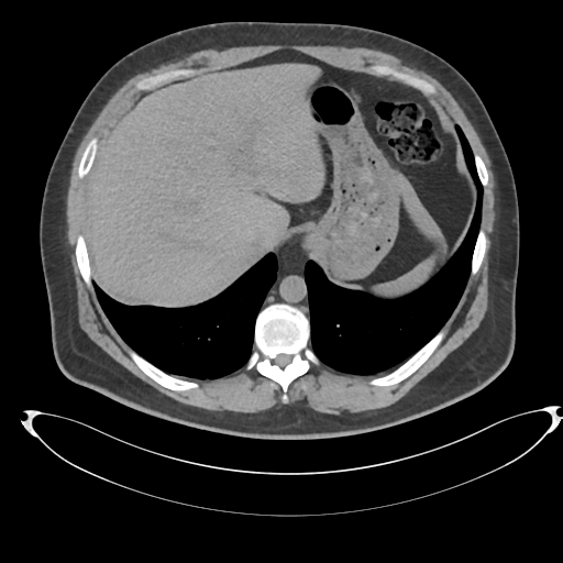 File:Adrenal cyst (Radiopaedia 45625-49778 Axial non-contrast 13).png