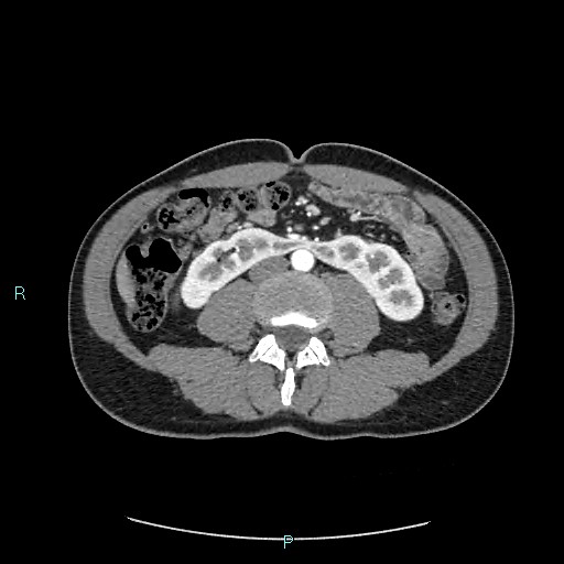 Adrenal cystic lymphangioma (Radiopaedia 83161-97534 Axial C+ arterial phase 52).jpg