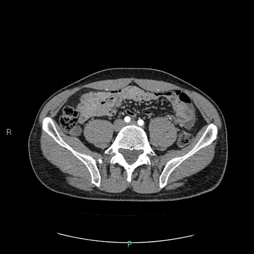 Adrenal cystic lymphangioma (Radiopaedia 83161-97534 Axial C+ arterial phase 65).jpg