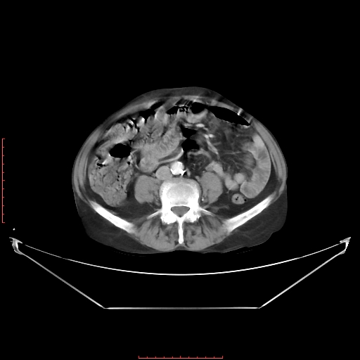 Adrenal hemangioma (Radiopaedia 68923-78668 Axial C+ portal venous phase 44).jpg