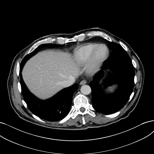 Adrenal lymphoma (Radiopaedia 73730-84529 Axial C+ portal venous phase 8).jpg