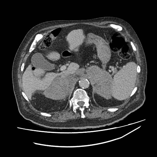Adrenal lymphoma (Radiopaedia 84145-99415 Axial C+ portal venous phase 23).jpg