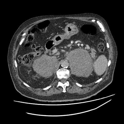 Adrenal lymphoma (Radiopaedia 84145-99415 Axial C+ portal venous phase 33).jpg