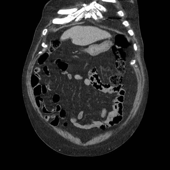 Adrenal lymphoma (Radiopaedia 84145-99415 Coronal C+ portal venous phase 14).jpg
