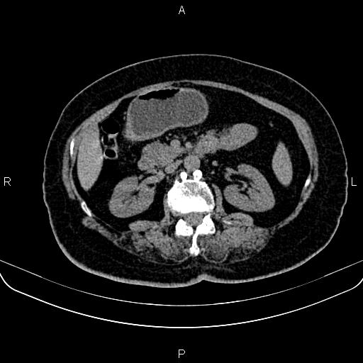 Adrenal myelolipoma (Radiopaedia 82742-96986 Axial non-contrast 67).jpg