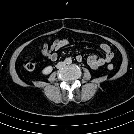 Adrenal myelolipoma (Radiopaedia 82742-96986 Axial renal excretory phase 92).jpg