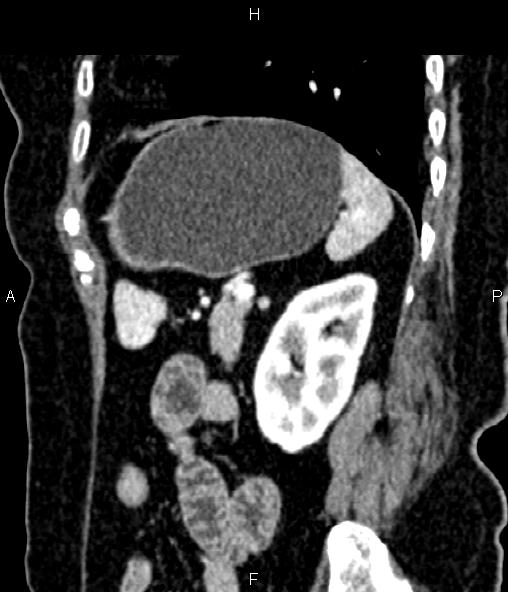 Adrenal myelolipoma (Radiopaedia 82742-96986 Sagittal renal cortical phase 80).jpg