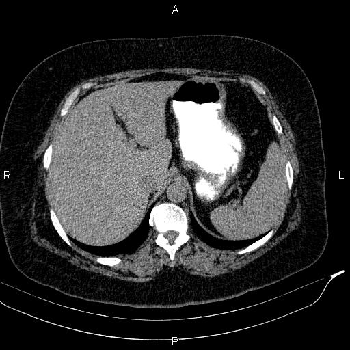 File:Adrenal myelolipoma (Radiopaedia 84319-99617 Axial With oral contrast 49).jpg