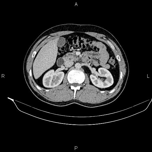 Adrenal myelolipoma (Radiopaedia 87794-104246 Axial renal cortical phase 41).jpg