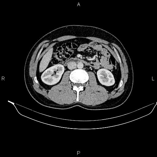 Adrenal myelolipoma (Radiopaedia 87794-104246 Axial renal cortical phase 50).jpg