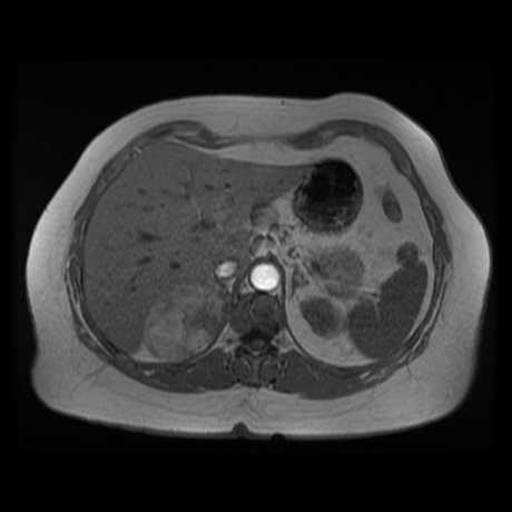 File:Adrenal myelolipoma - MRI (Radiopaedia 83249-97646 Axial T1-in phase 7).jpg