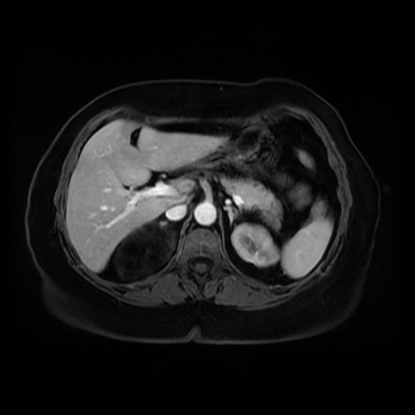 Adrenal myelolipoma - MRI (Radiopaedia 83249-97646 T1 fat sat arterial phase 29).jpg
