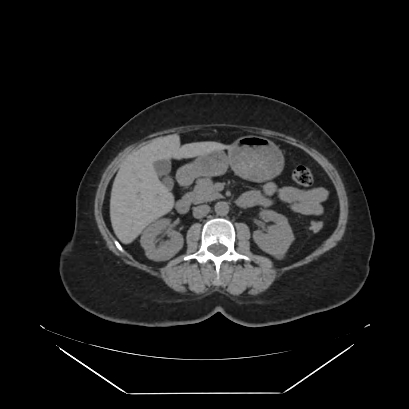 File:Adrenal myelolipoma - MRI (Radiopaedia 83249-97647 Axial non-contrast 60).jpg