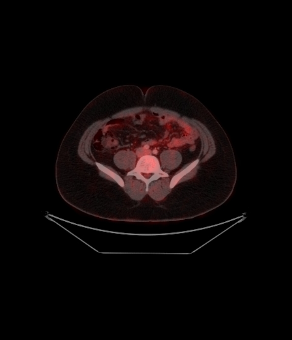 Adrenocortical carcinoma (Radiopaedia 80134-93440 ِAxial 209).jpg