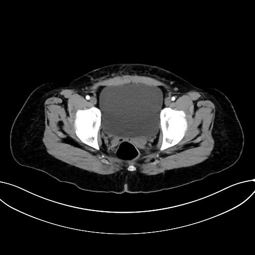 Adrenocortical carcinoma (Radiopaedia 87281-103569 Axial C+ arterial phase 82).jpg