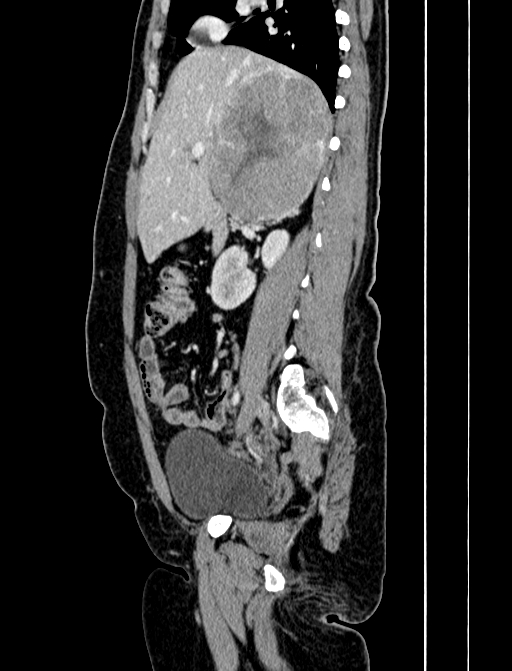 Adrenocortical carcinoma (Radiopaedia 87281-103569 Sagittal C+ portal venous phase 103).jpg
