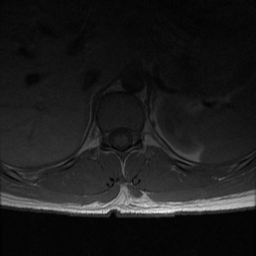 File:Aggressive vertebral hemangioma (Radiopaedia 39937-42404 Axial T1 8).png