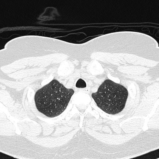 File:Air trapping in small airway disease (Radiopaedia 61685-69694 Axial lung window 22).jpg