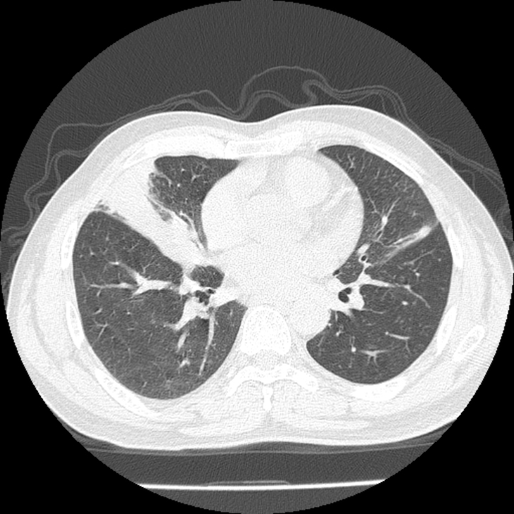 Airway foreign body in adult (Radiopaedia 85907-101779 Axial lung window 105).jpg