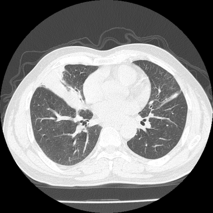 Airway foreign body in adult (Radiopaedia 85907-101779 Axial lung window 106).jpg