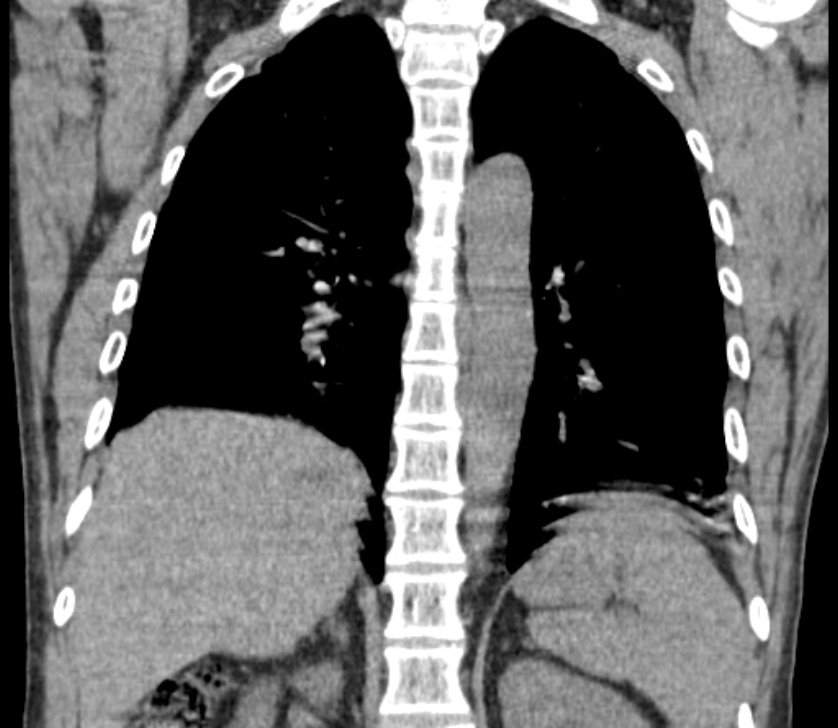Airway foreign body in adult (Radiopaedia 85907-101779 Coronal liver window 180).jpg