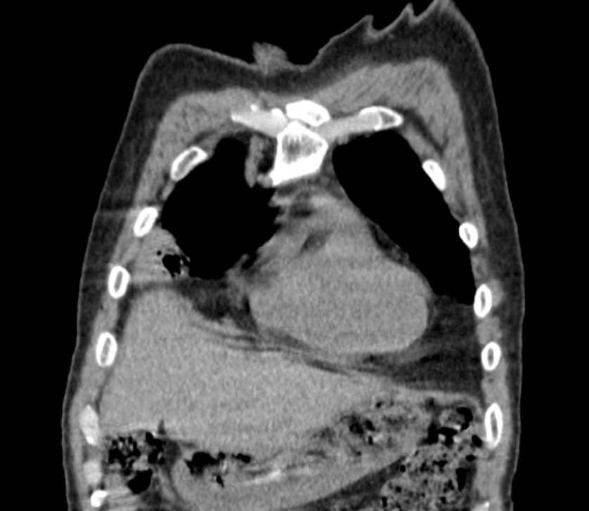 Airway foreign body in adult (Radiopaedia 85907-101779 Coronal liver window 39).jpg
