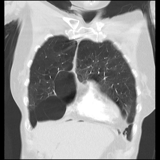 File:Alpha-1-antitrypsin deficiency (Radiopaedia 64893-73840 Coronal lung window 7).jpg