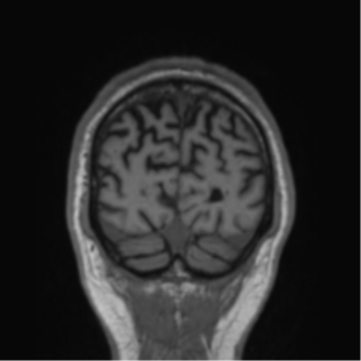 Alzheimer's disease- with Gerstmann syndrome and dressing apraxia (Radiopaedia 54882-61150 Coronal T1 13).png
