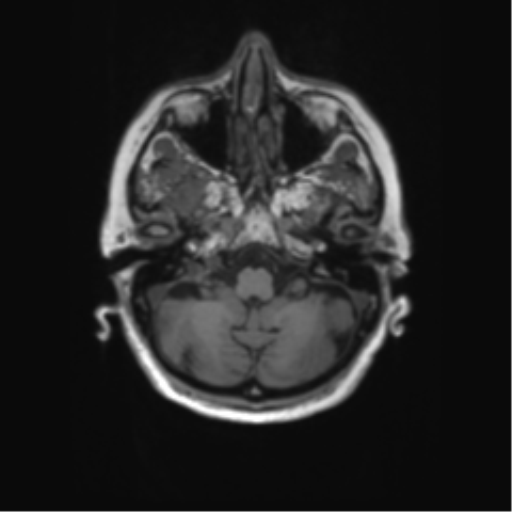 File:Alzheimer's disease (Radiopaedia 42658-45802 Axial T1 124).png