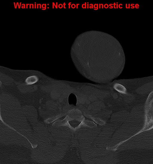 Ameloblastoma (Radiopaedia 33126-34164 Axial bone window 42).jpg