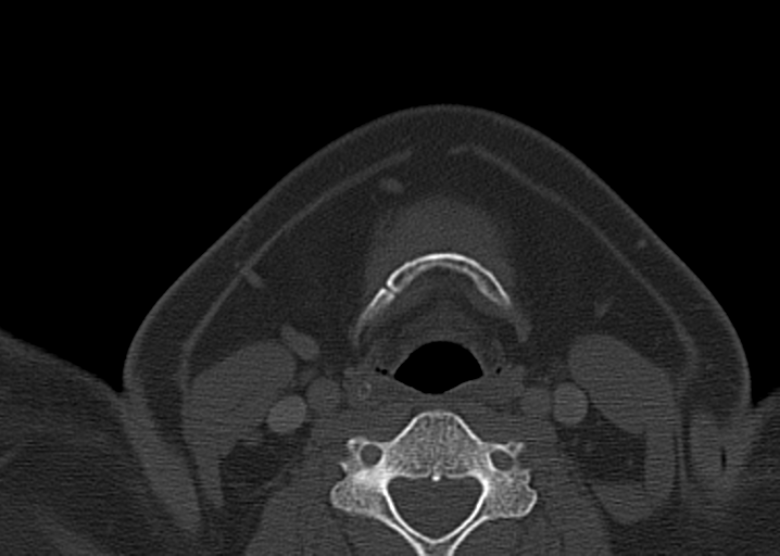 Ameloblastoma (Radiopaedia 38520-40623 D 46).png