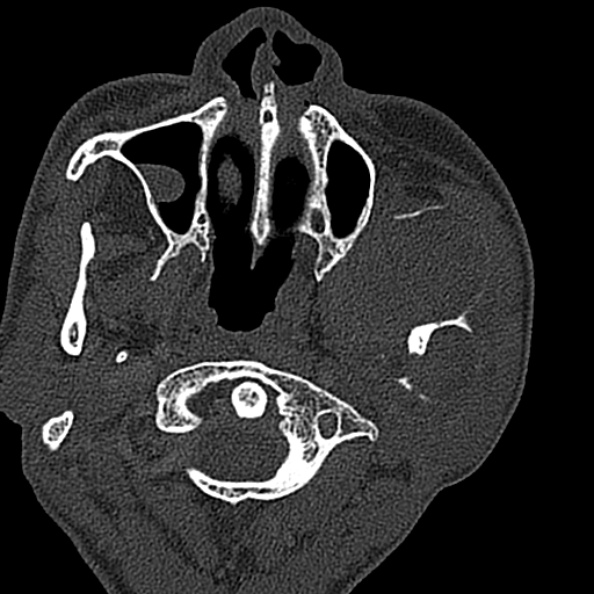 Ameloblastoma (Radiopaedia 51921-57766 Axial bone window 113).jpg