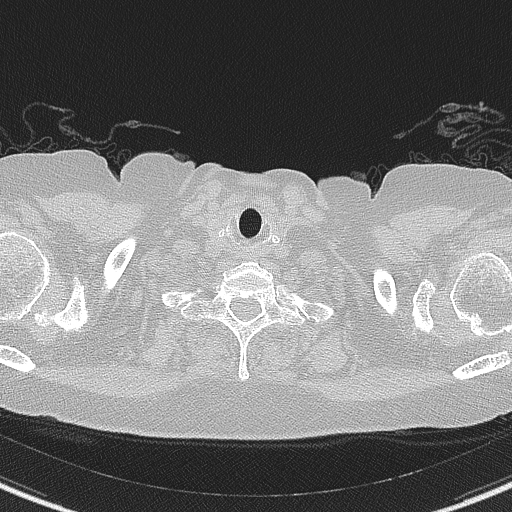 Amiodarone-induced pulmonary fibrosis (Radiopaedia 82355-96460 Axial lung window 1).jpg