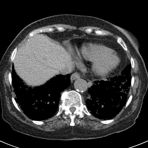 Amiodarone-induced pulmonary fibrosis (Radiopaedia 82355-96460 Axial non-contrast 48).jpg