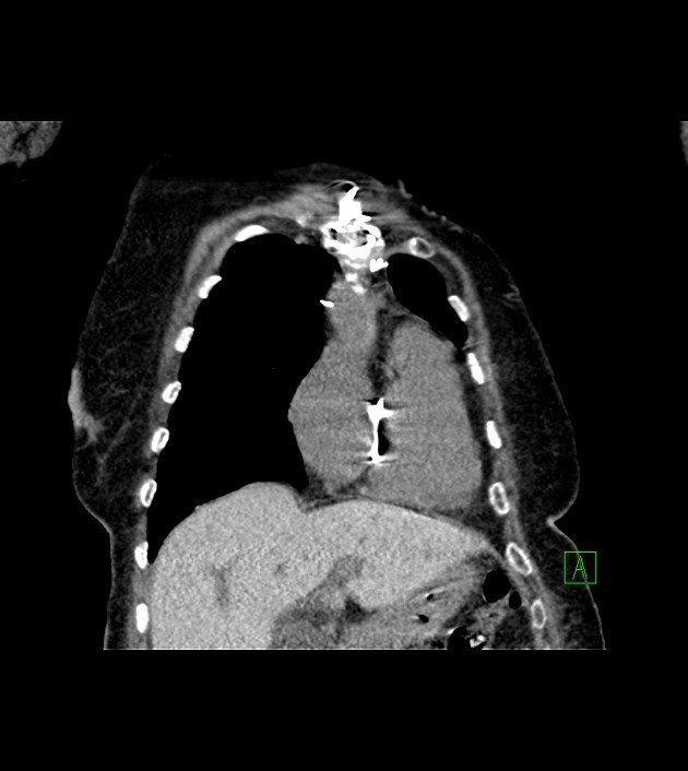 Amiodarone deposition in the liver (Radiopaedia 77587-89780 Coronal non-contrast 23).jpg