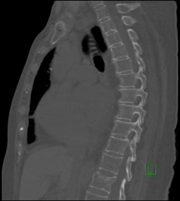 Amiodarone deposition in the liver (Radiopaedia 77587-89780 Sagittal bone window 52).jpg