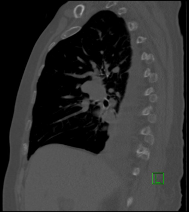 Amiodarone deposition in the liver (Radiopaedia 77587-89780 Sagittal bone window 63).jpg