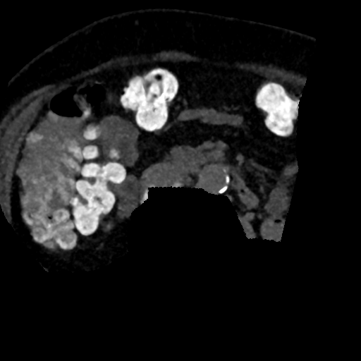 Ampullary adenocarcinoma (Radiopaedia 34013-35241 AXIAL MIPS 3-1.5 94).png