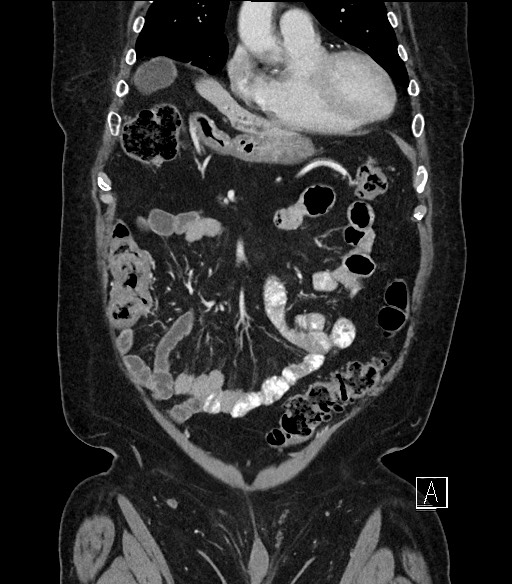 Ampullary adenocarcinoma (Radiopaedia 59373-66734 D 22).jpg