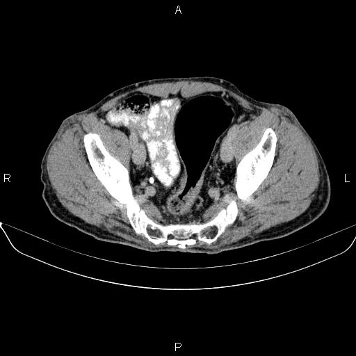 Ampullary adenocarcinoma (Radiopaedia 86093-102032 Axial C+ delayed 89).jpg